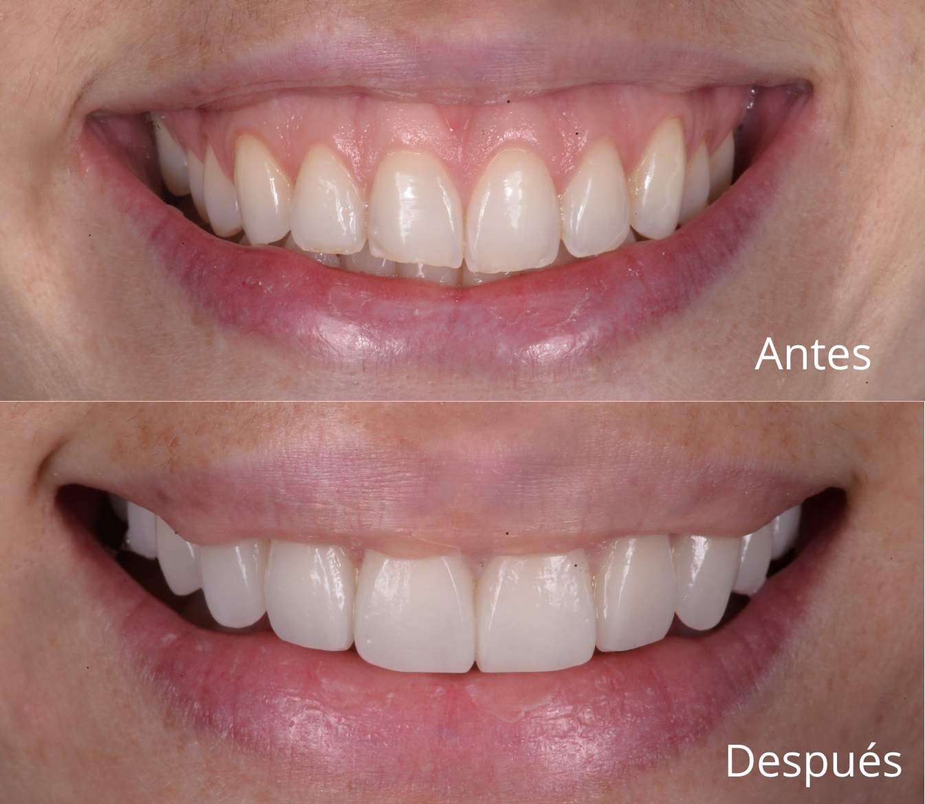blanqueamiento dental