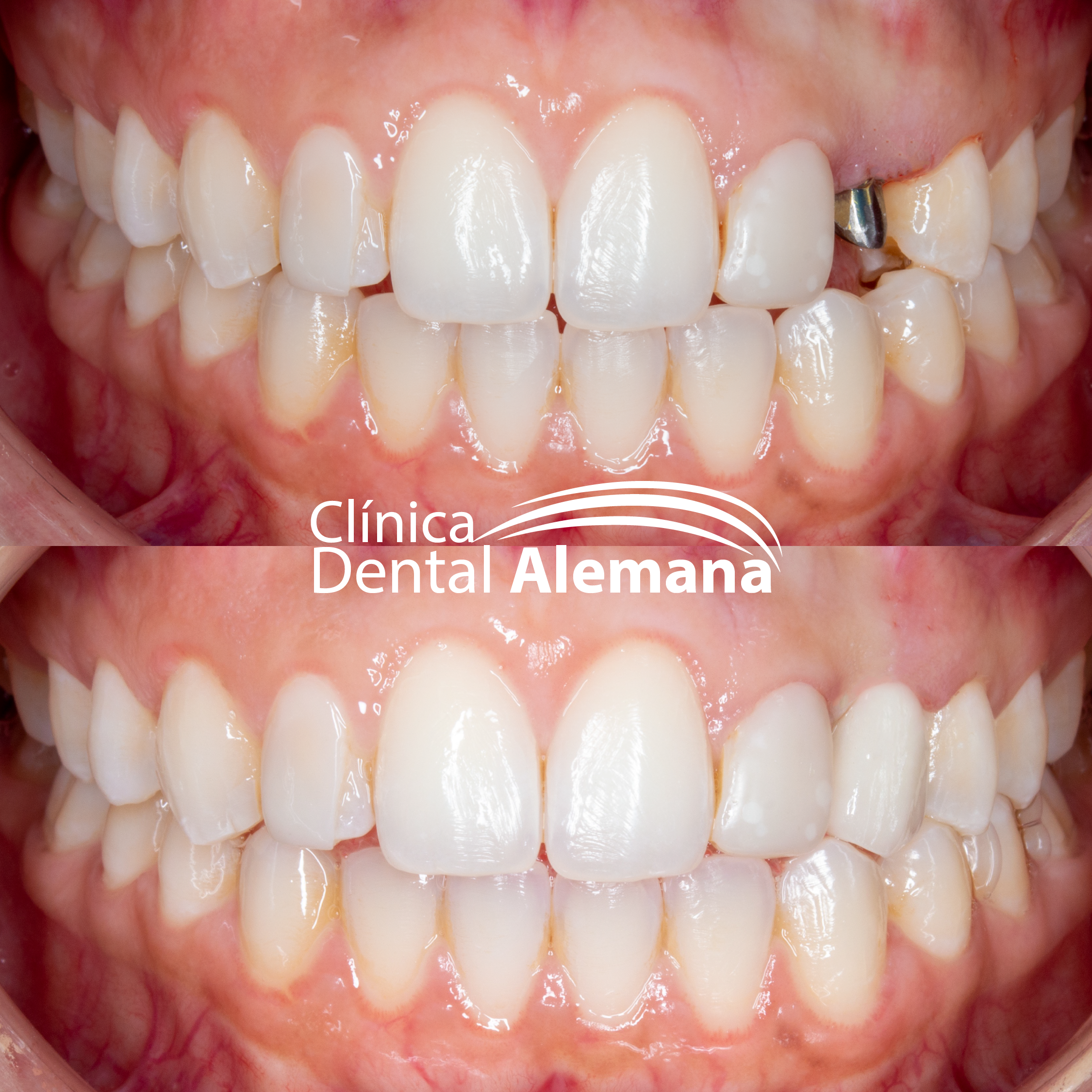 Implantología dental