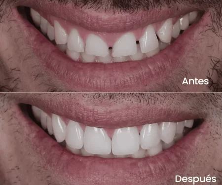 antes-despues-nuevo
